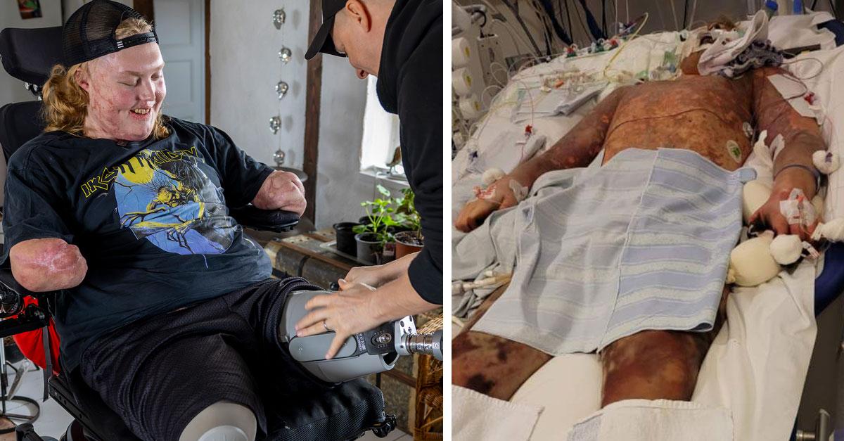 Viktor, 18, lost both arms and legs due to meningococcal sepsis.