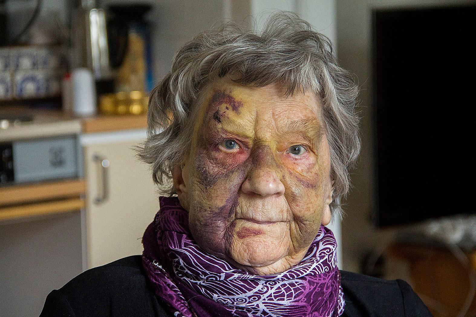 95-åriga Karin Forslund efter att ha fallit när hon försökt ta sig till toaletten på egen hand. Hon ville inte störa den stressade personalen på hennes äldreboendet.