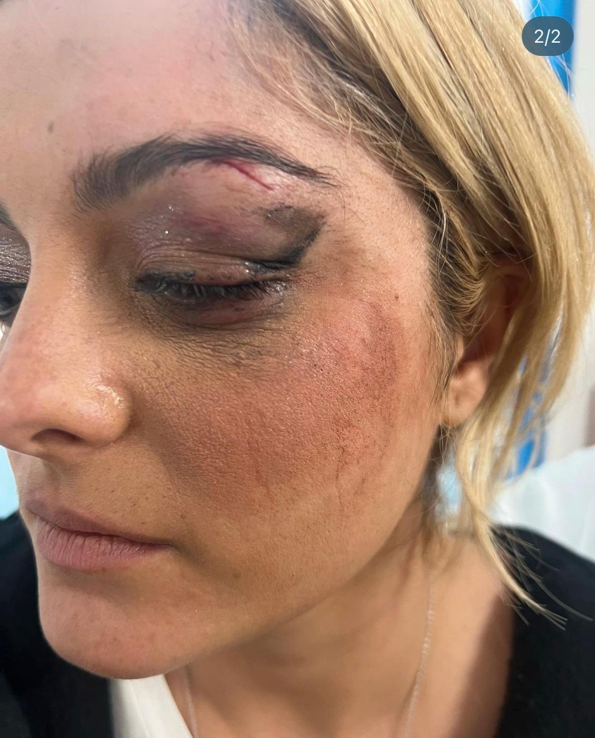 Bebe Rexha delade Instagrambilder på sitt blåslagna ansikte efter attacken. 