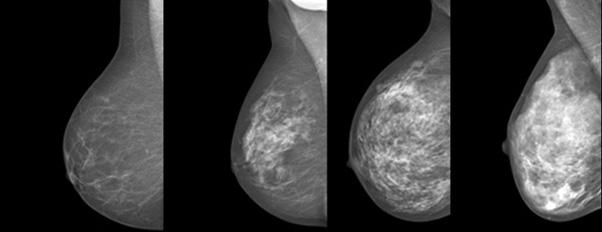 Mammografibilder på bröst med olika grad av täthet. Det vitaste bröstet längst till höger har högst täthet.