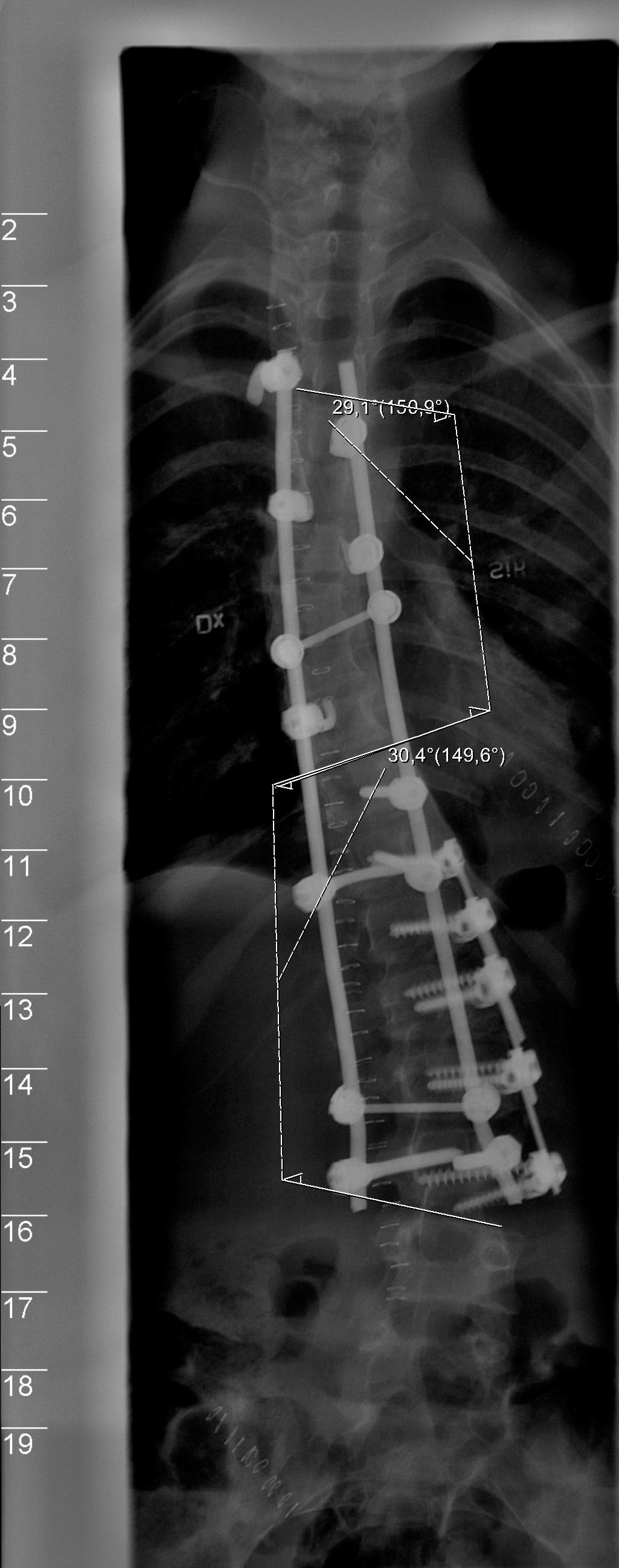 ÅR 2002: Röntgen på ryggraden efter första steloperationen. Den nedersta skruven gick rakt in i disken mellan ryggkotorna L3 och L4 och vållade henne svåra smärtor i tio år.