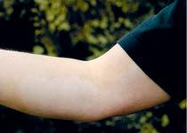 Vita fläckar vid armbågar, händer och ansikte är vanligt hos de drabbade.