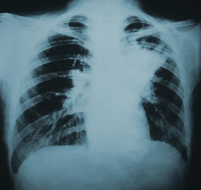 Röntgenbild av lungor som infekterats med blastomykos. Arkivbild.