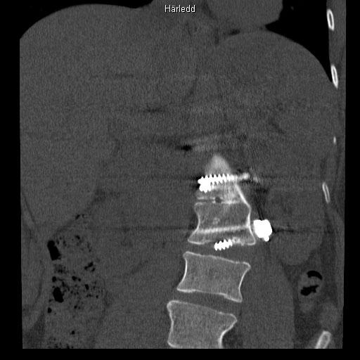 Här syns det tydligt att skruven sitter i disken mellan ryggkotorna. Röntgen 2009.