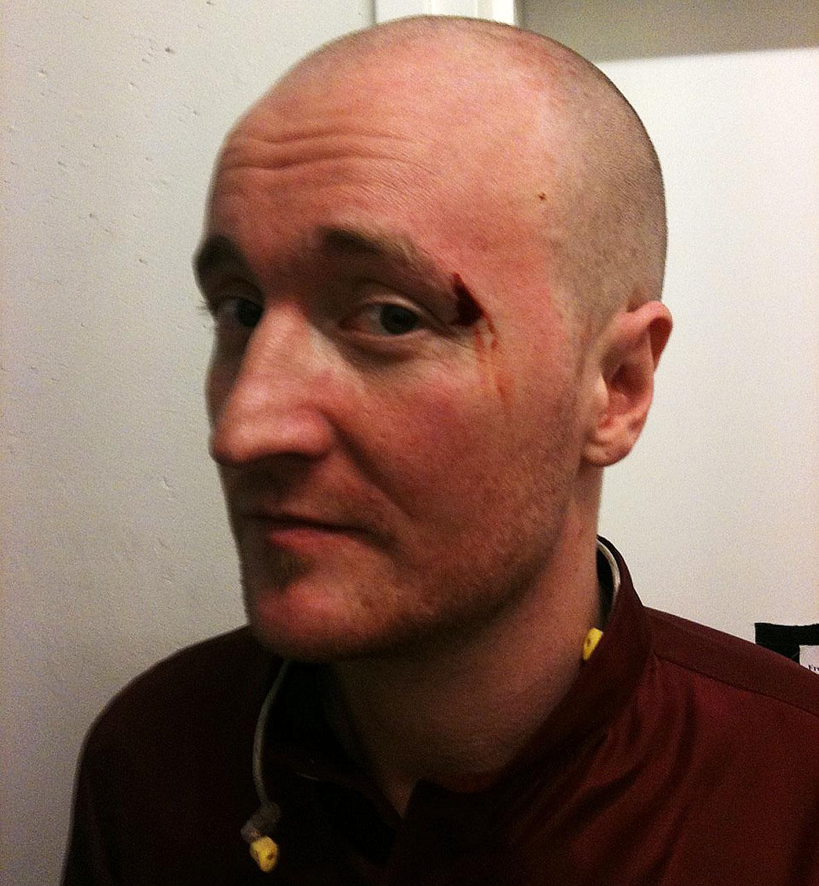 SPRUCKET ÖGONBRYN Daniel ”The Moniker” Karlsson råkade slå mickstativet så hårt mot huvudet att han fick ett blodigt sår under gårdagens repetition.