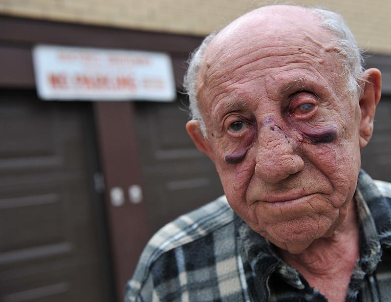 Steve Pulwers, 99, fick näsan och flera revben knäckta i ett slagsmål med en 83-åring.