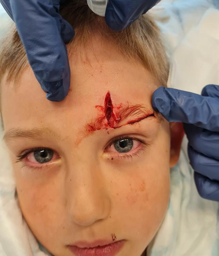 Elliot, 7, lekte på skolgården när han blev påkörd av en kille på elsparkcykel.