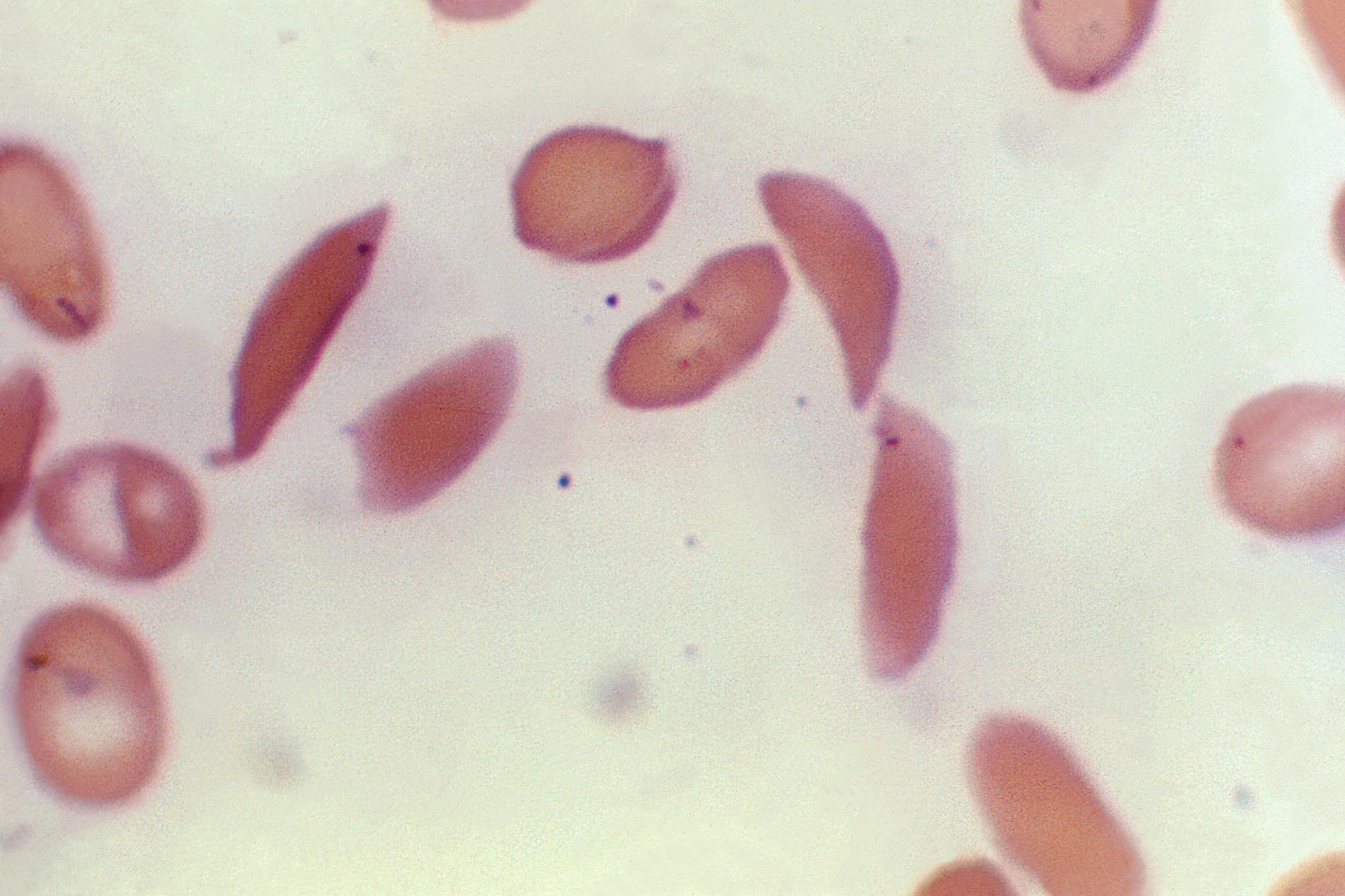 Röda blodkroppar hos en patient som led av sjukdomen sicklecellanemi. Arkivbild.