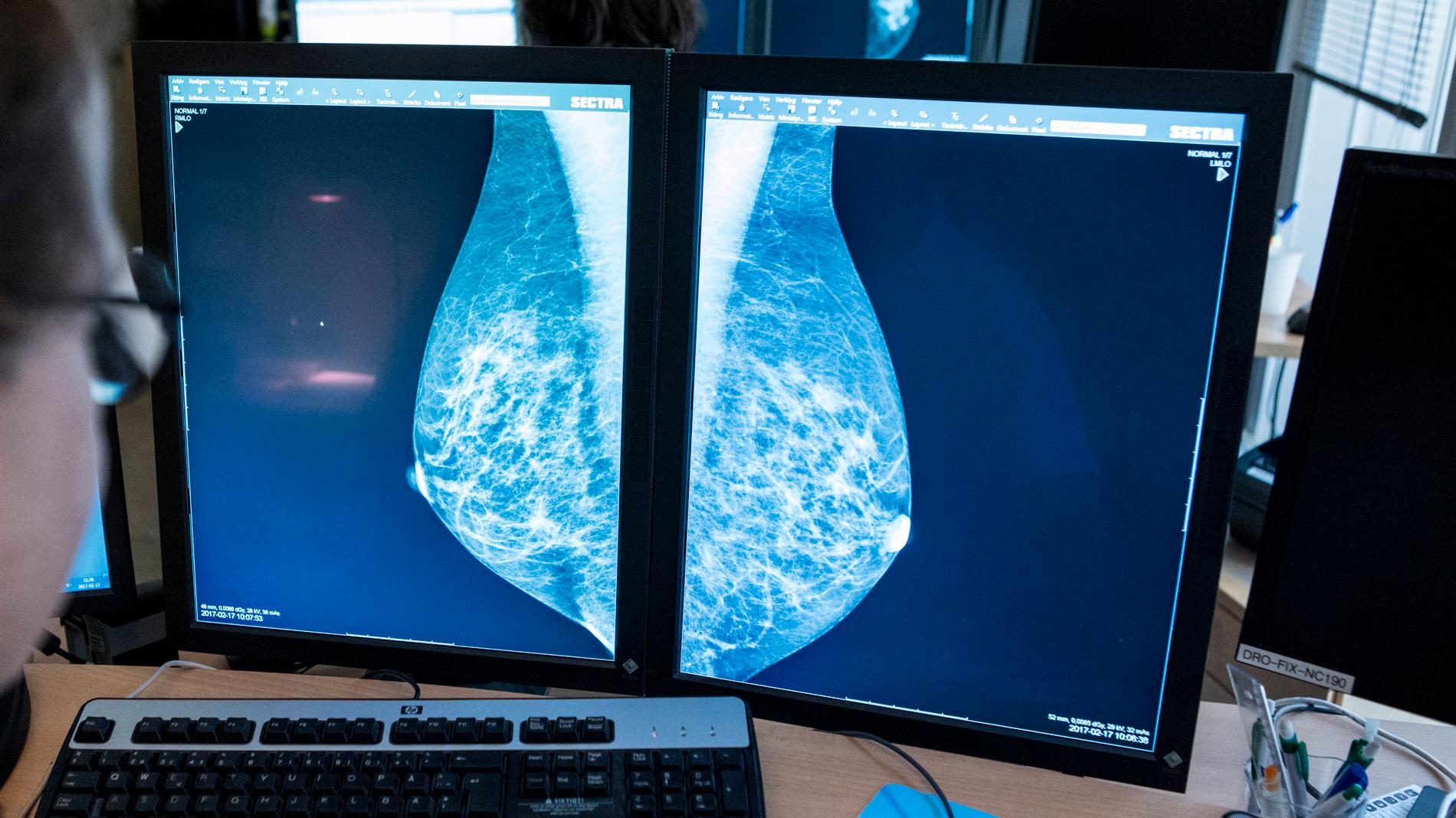 Bröstcancer är egentligen elva olika sjukdomar, menar forskare. Arkivbild.