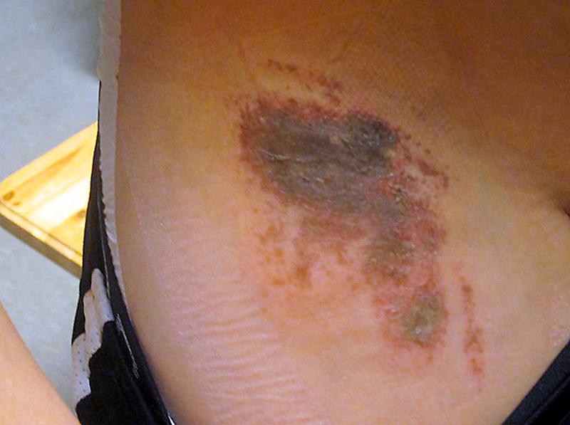 Den här bilden på Theodors sår togs bara fyra timmar efter läkarbesöket på lasarettet i Nyköping.