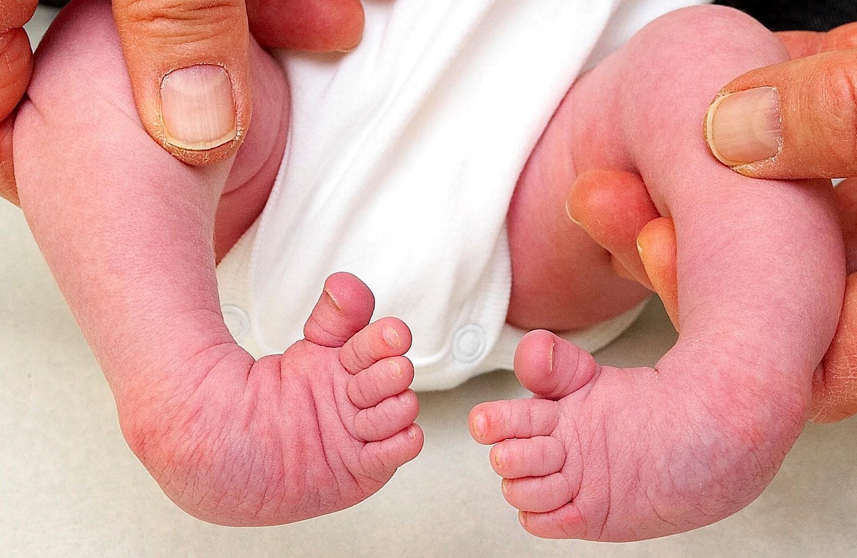 Nyfödd bebis med klumpfot som har drabbat båda fötterna.