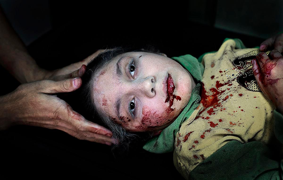 Överlevde bomben Danila Kilsi vårdades för splitterskador på sjukhuset i Aleppo när Niclas Hammarström tog den här bilden.