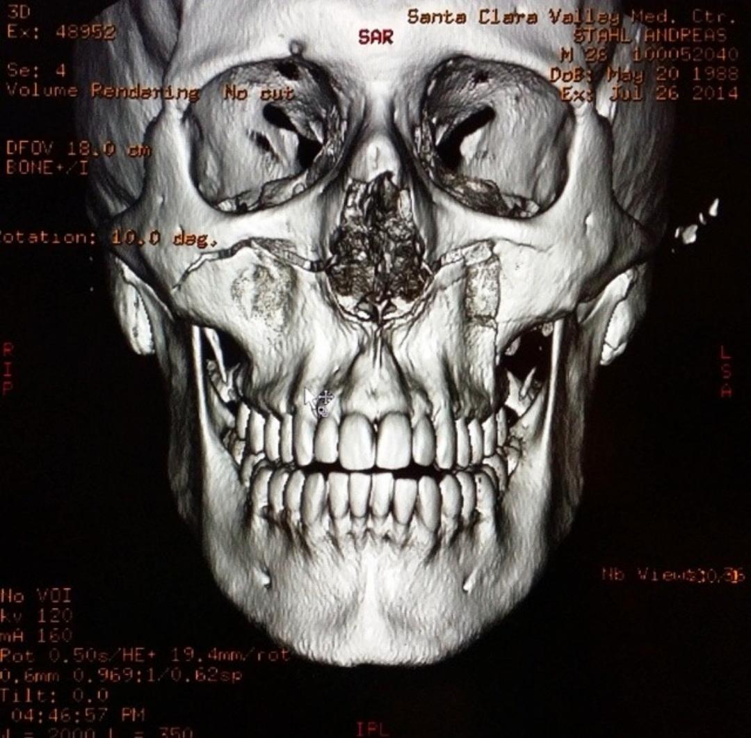 Röntgenbild på Ståhls otäcka skada. 