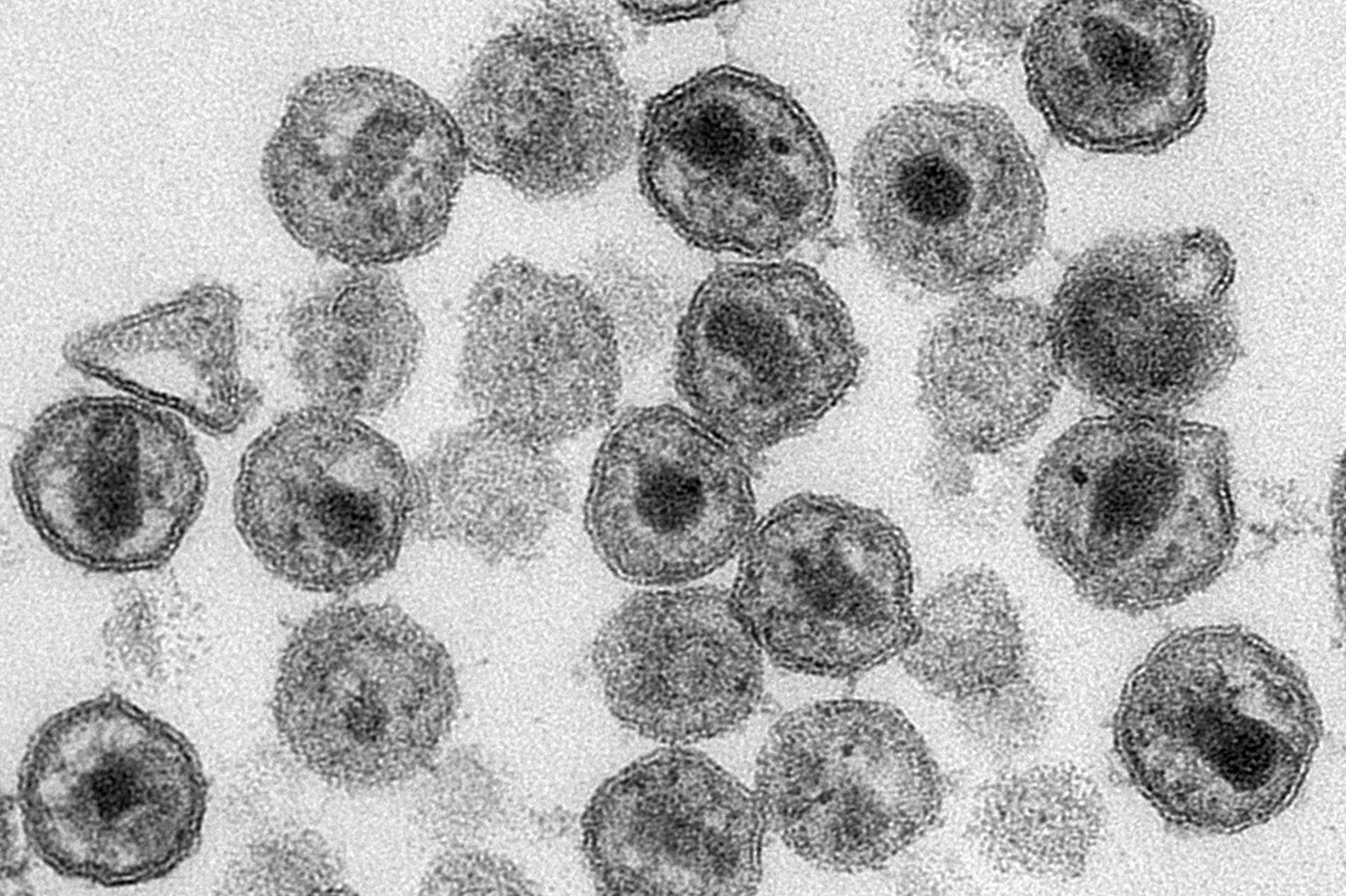 Forskning pågår för att stoppa hiv-infektion, bland annat genom arbete med blodceller, som på denna mikroskopbild tillhandahållen av CDC (Centers for Disease Control). I ett försök uppges stamcellstransplantation uppges ha fungerat på en hiv-smittad person i London. Arkivbild.