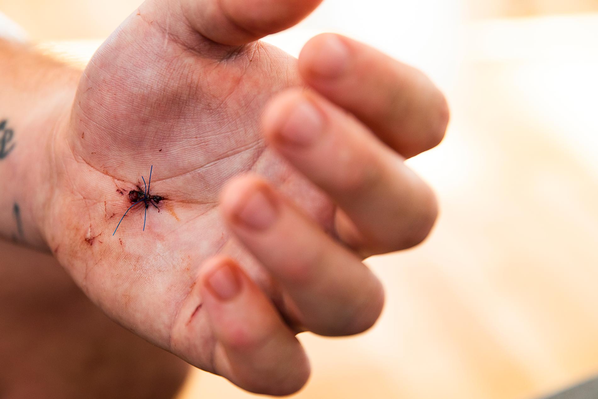 En ven gick sönder i handflatan av ett av knivhuggen och han kan fortfarande inte böja på fingrarna.