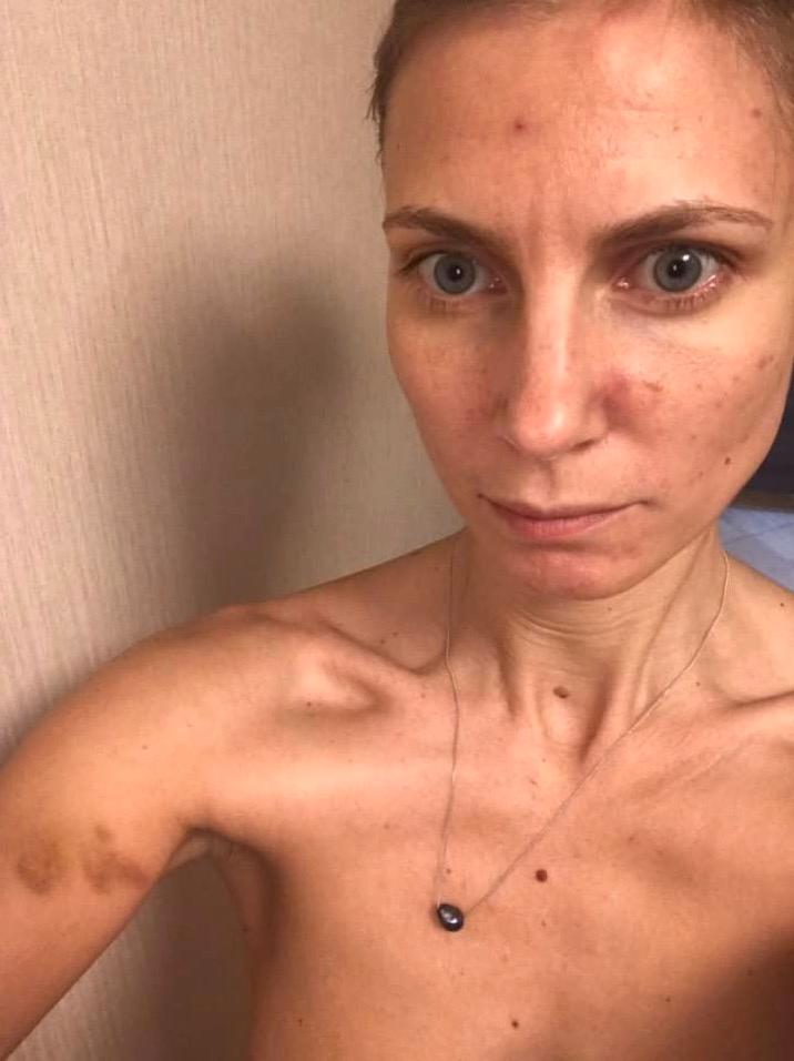 Irina Zjivova efter makens misshandel 20 oktober 2019.