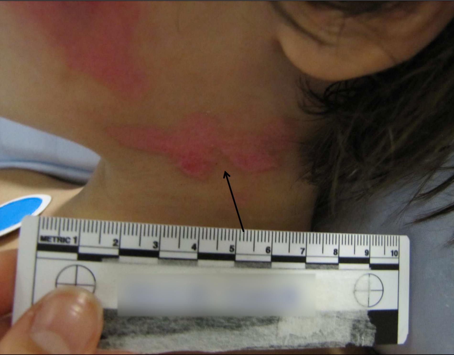 Sjukhuspersonal konstaterade 32 olika skador på femåringens kropp. Bild från polisens förundersökningsprotokoll.