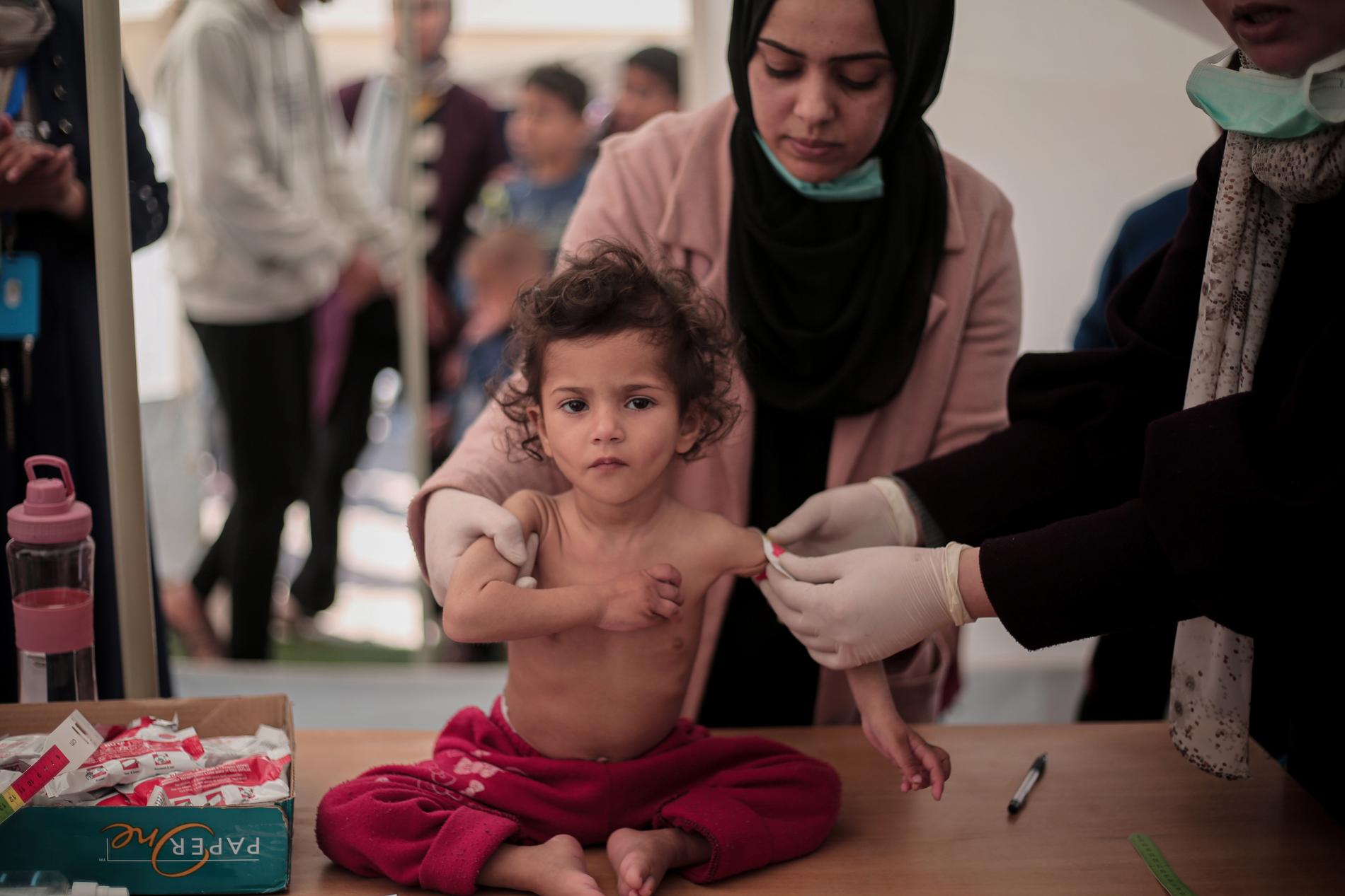 Leen, 2 år, är akut undernärd enligt screeningen görs på hennes arm. Före kriget fick flickan mediciner och fysioterapi för att hålla vikten, men familjen blev flyktingar under kriget och Leens hälsa har markant försämras. Hon väger nu endast 7 kilo, och har förts till al-Awda-sjukhuset i norra Gaza för specialistvård. Flickan är nu på bättringsvägen. Bilden är tagen av Unicefs team under helgen. 