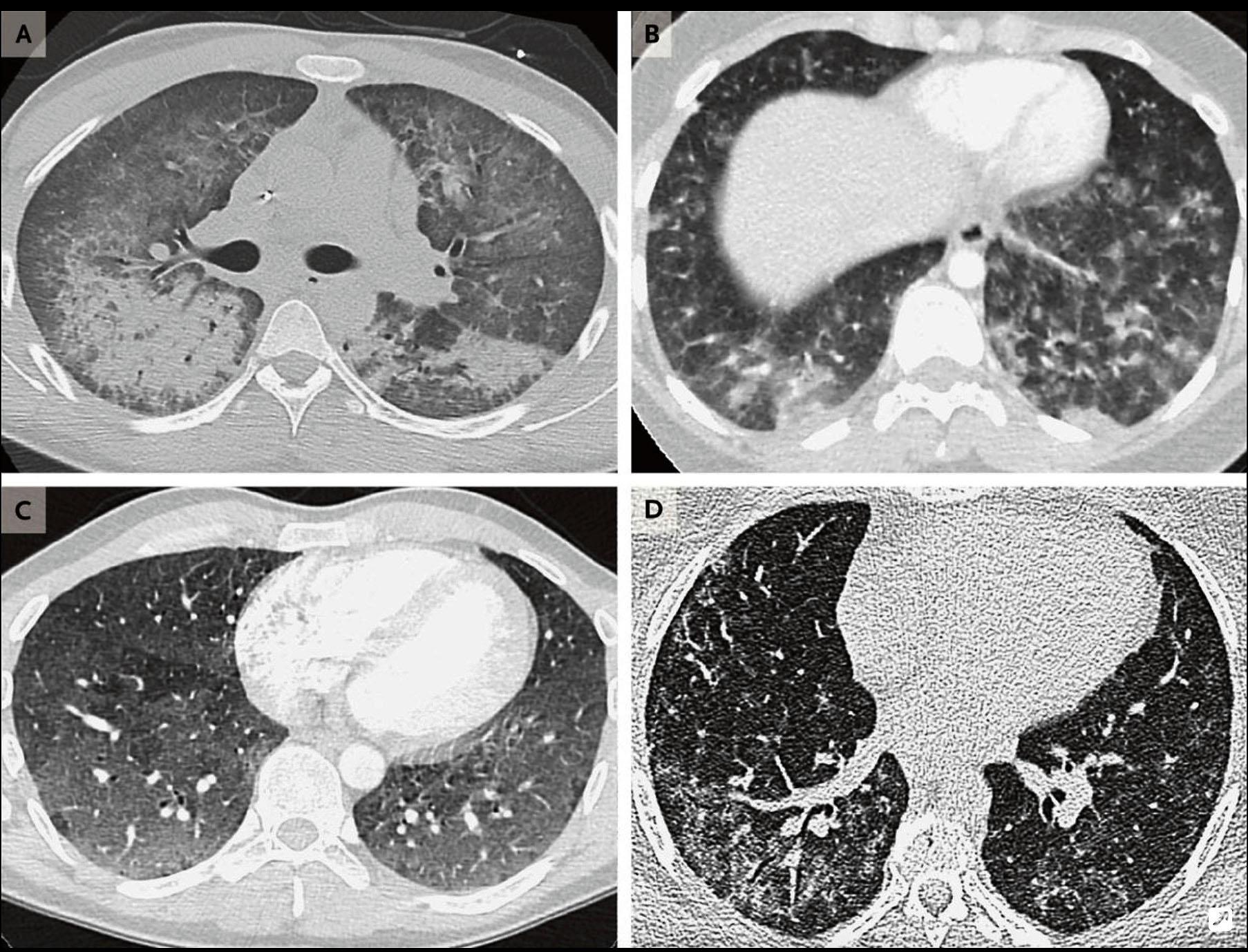 Röntgenbilder som visar skador på lungorna på patienter i åldrarna 19–49.