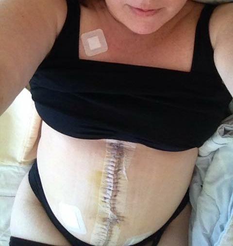 Jenny på sjukhuset drygt en vecka efter den stora operationen, i april 2015. Magen är uppsvälld och lika rund som på en höggravid –vilket var tufft att hantera.