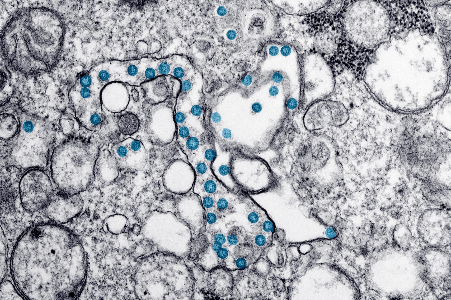De blå prickarna är partiklar av coronaviruset. Bilden är tagen i mikroskop.