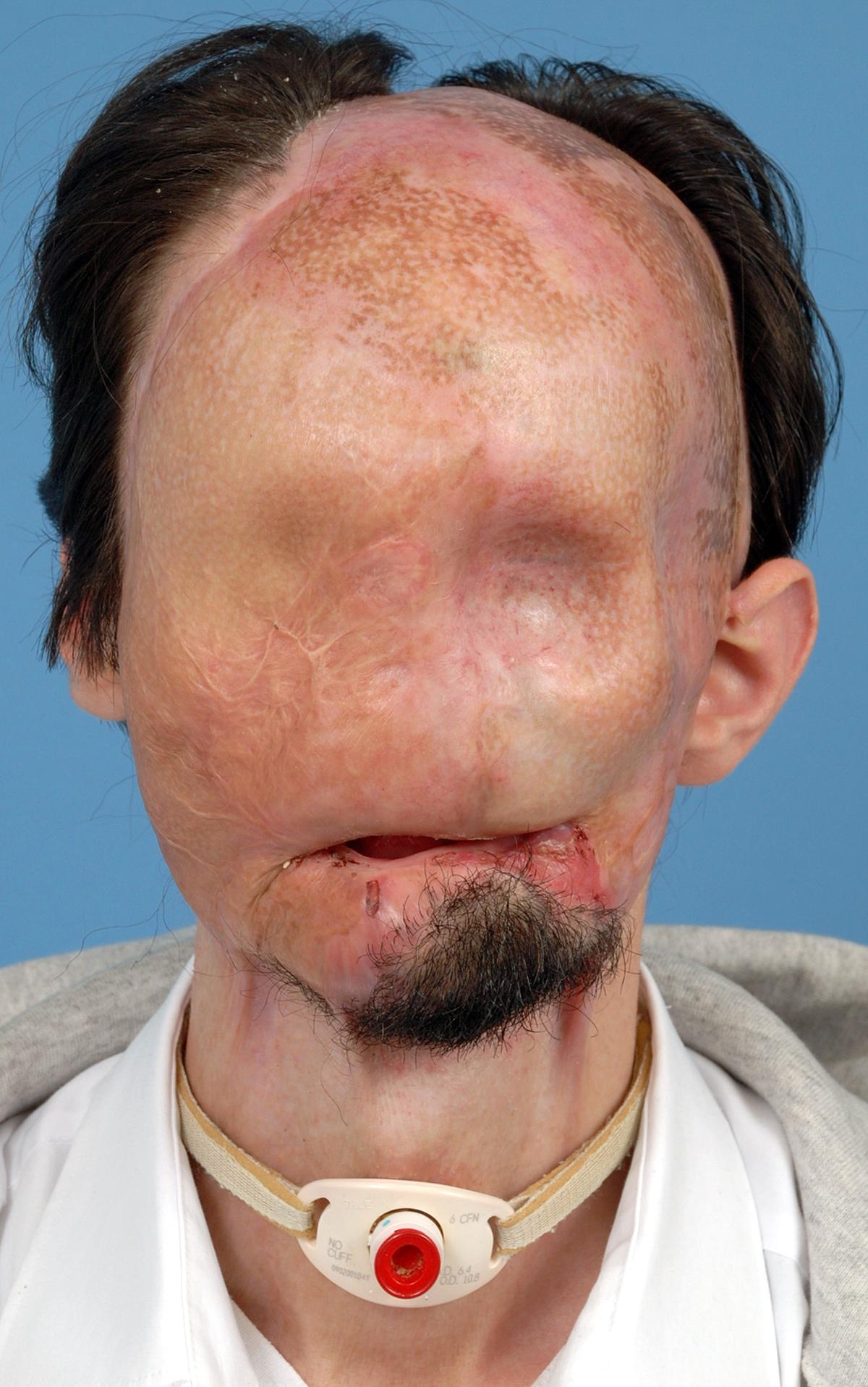 Så här såg Dallas ut före operationen. Olyckan har bränt bort hela ansiktet.