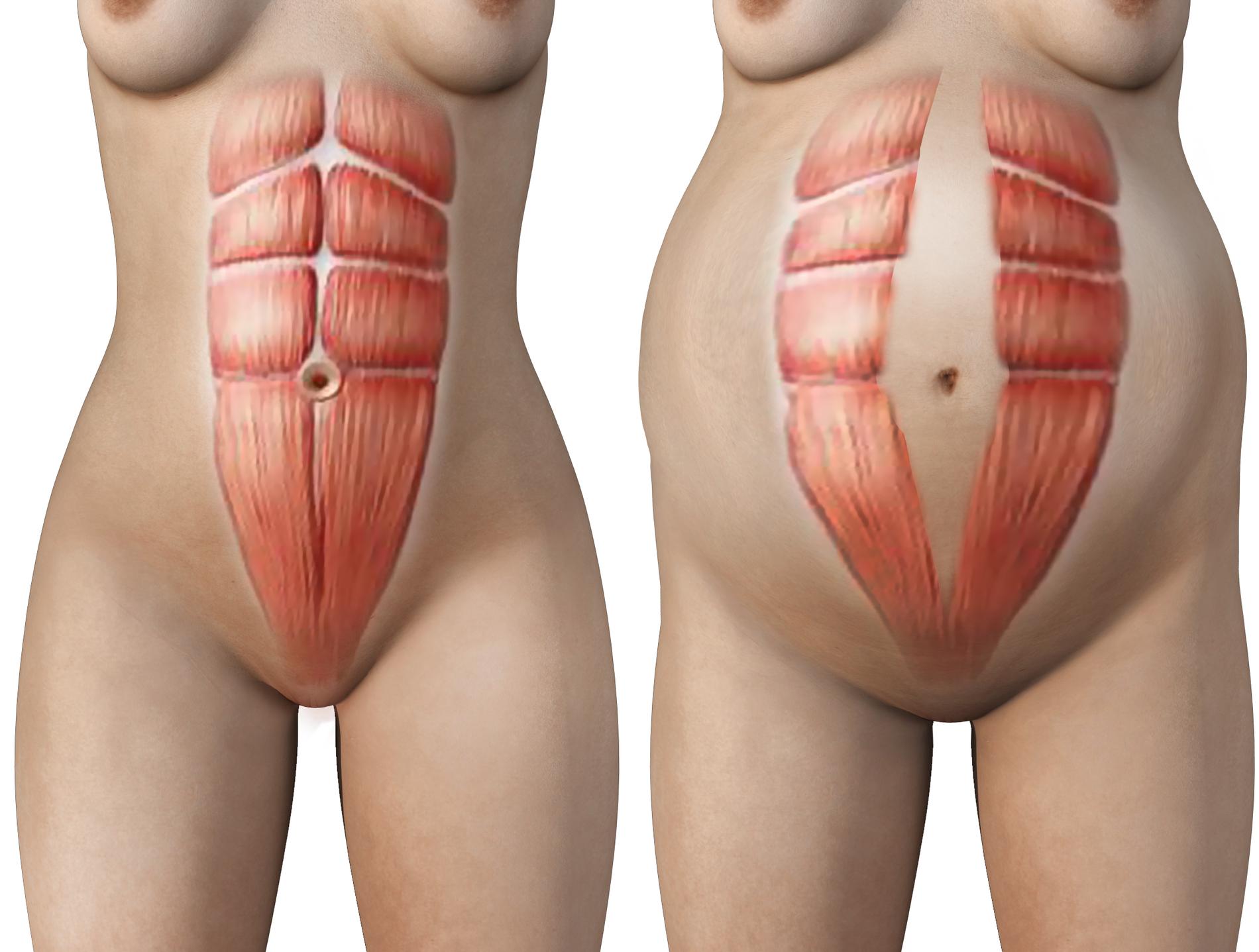 Musklernas naturliga läge (till vänster) och musklerna under diastas.
