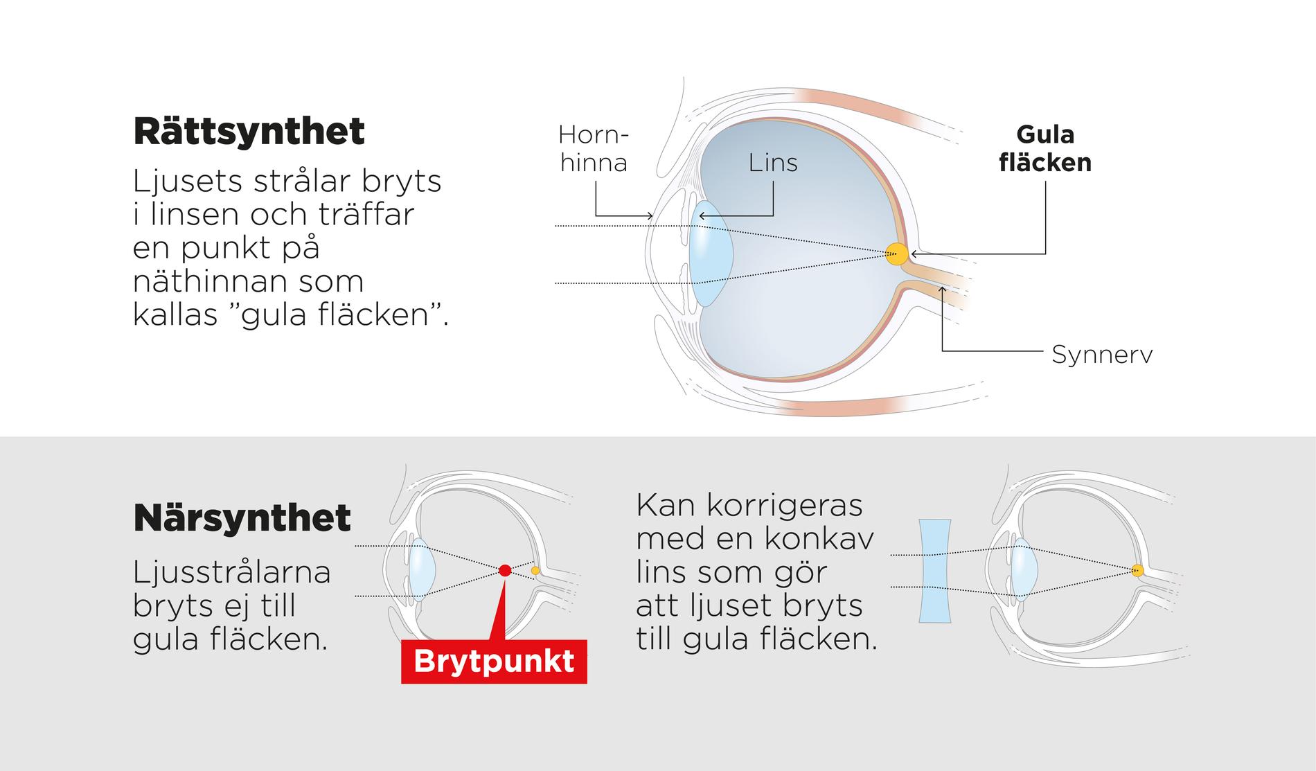 Ett närsynt öga har växt vilket ökar risken för synskador.