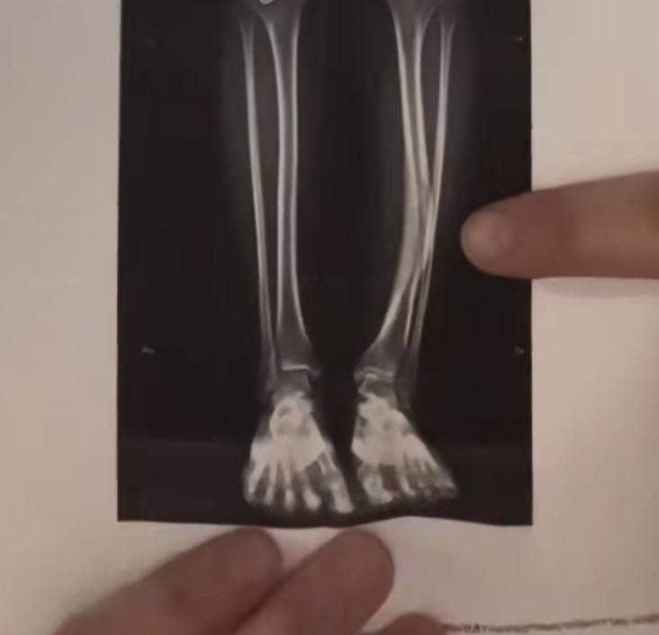 Röntgenbild från 2009 på Isabels ben. 