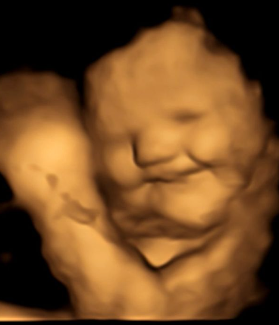 Så här ser ett foster ut där mamman ätit morotskapsel.