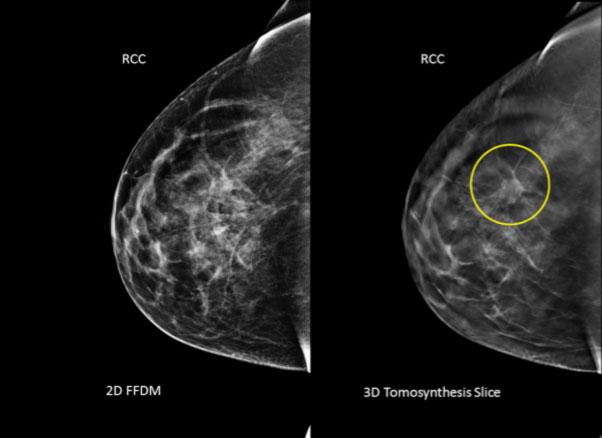 Bröstcancer är vanligaste cancern bland kvinnor i Sverige.