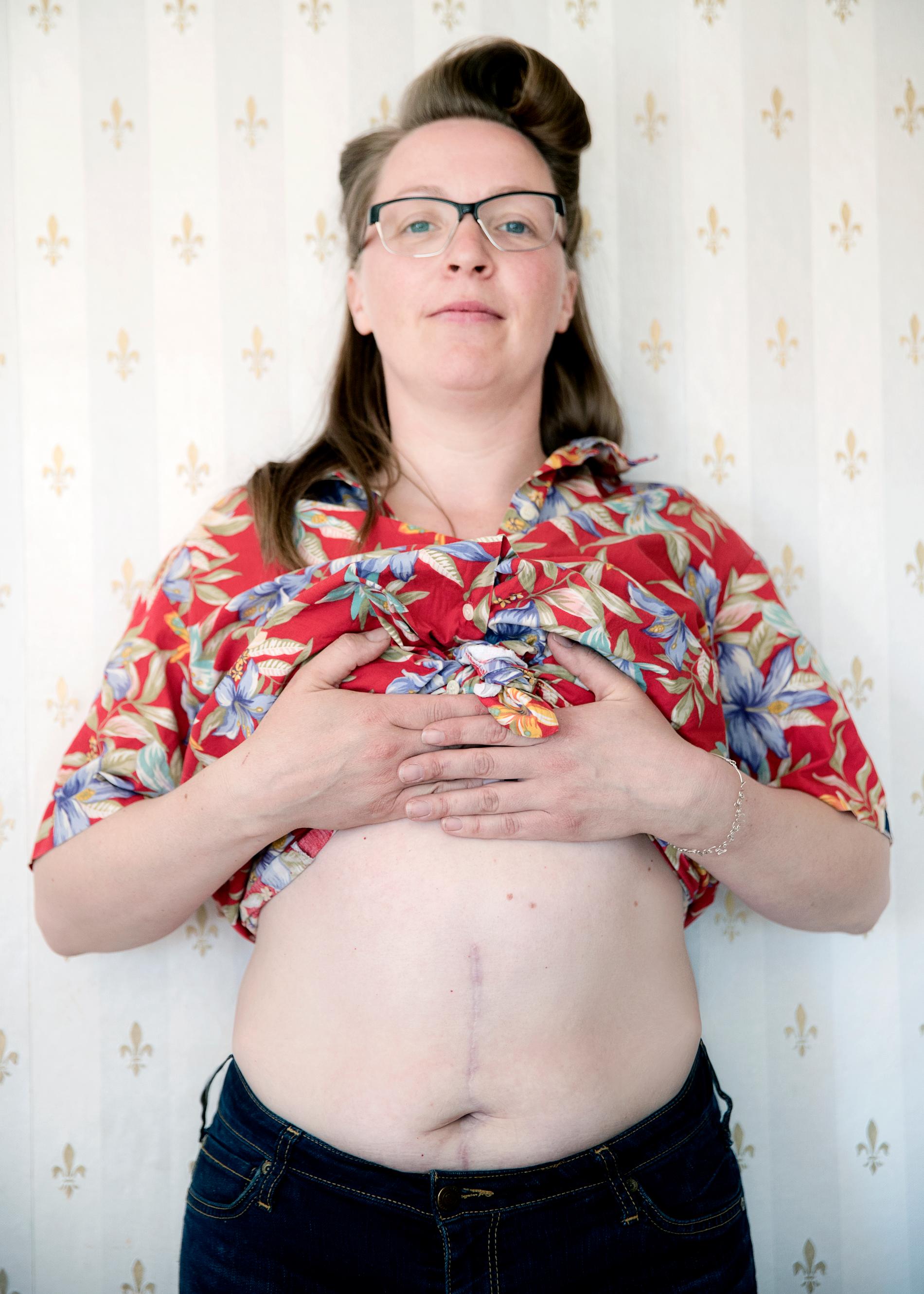 Jenny Aakula, 41, drabbades även av bukväggsdiastas - delad bukvägg - efter sin andra förlossningen. Hon kunde inte spänna magmusklerna och det dröjde två år innan hon fick en operation. 
