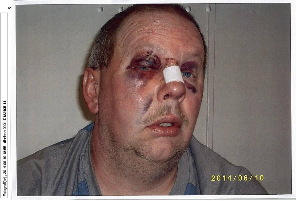 Anders Eklund var rejält blåsalagen efter misshandeln och han fick sys på näsan.
