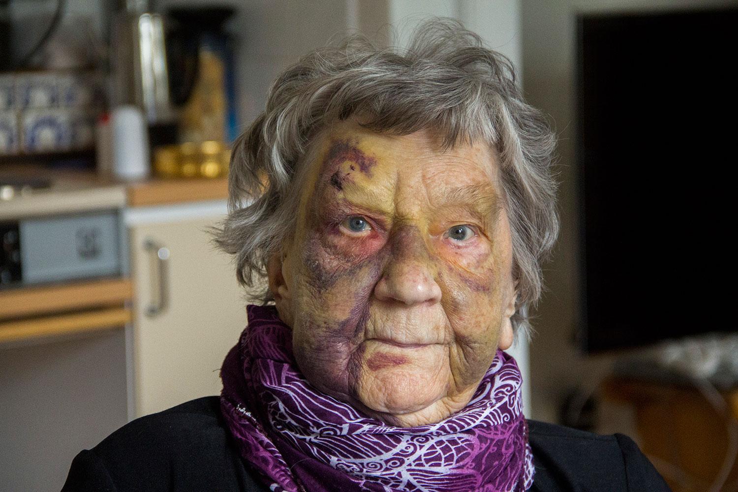 I själva verket föreställer bilden Karin Forslund, som ramlade flera gånger på sitt vård- och omsorgsboende i Söderhamn 2014.