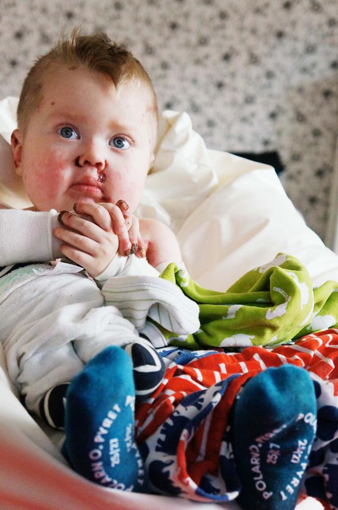 KÄMPADE VAR DAG.  Läkarna gav Hugo Törnqvist högst åtta månader i livet, men han kämpade modigt till sin tredje födelsedag. I söndags morse orkade den lilla kroppen inte mer. 
