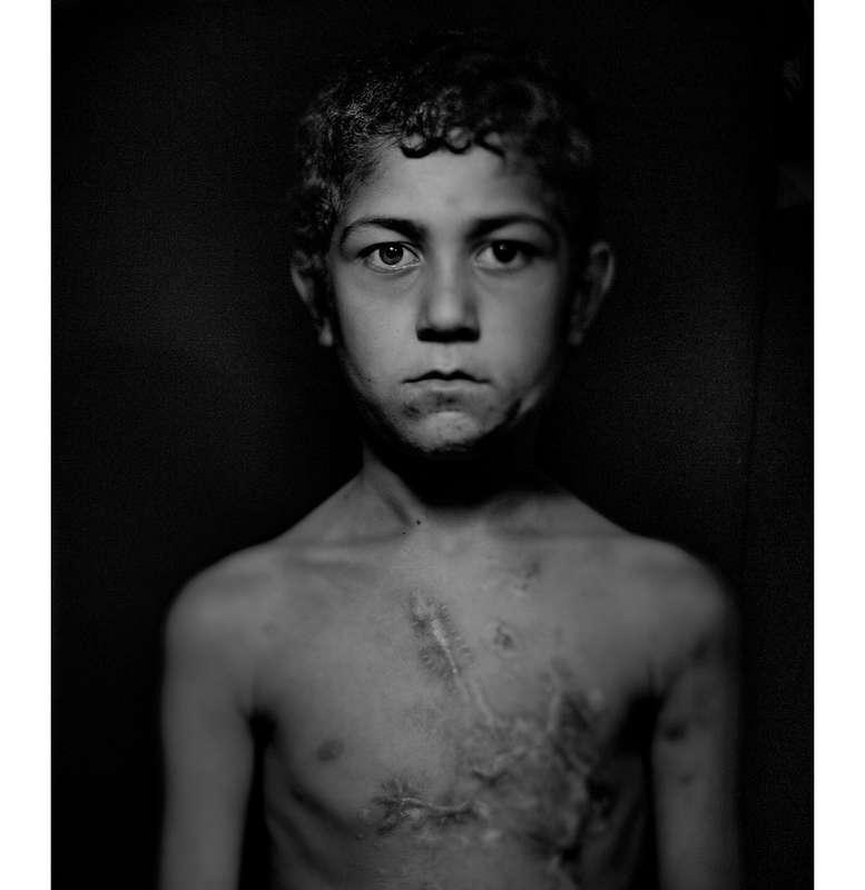 På flykt undan kriget i Syrien trampade tioåriga Shiar på en mina. Han förlorade hela vänsterhanden och hans överkopp är täckt av ärr. Från reportaget #jagbryrmig