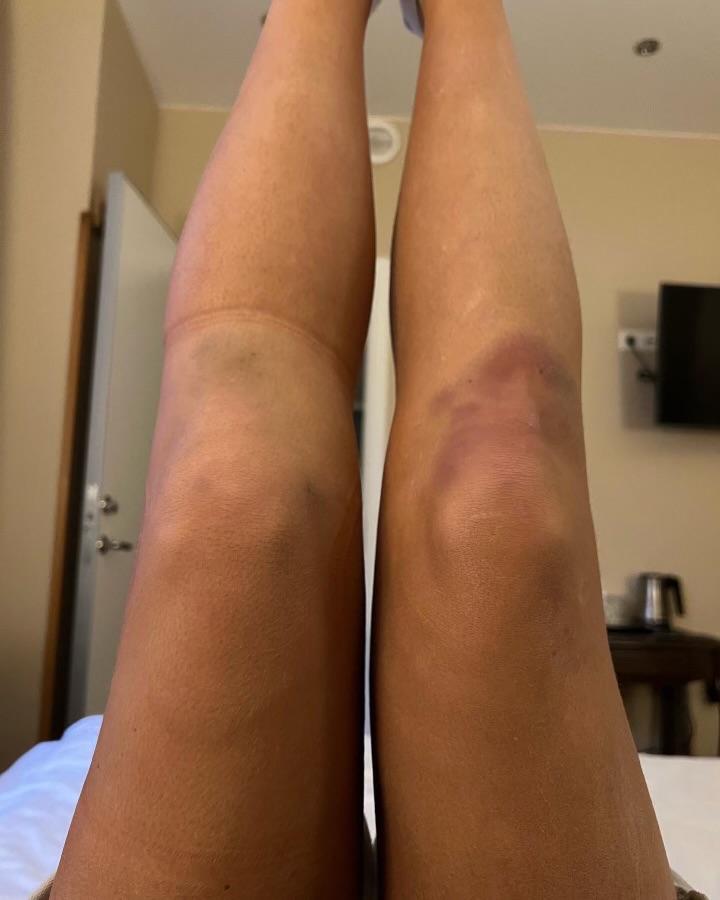 Bild på Lisa Anckarmans svullna vänsterknä efter skadan. Även det högra blev lite blåslaget eftersom hon använde det så mycket i tävlingarna. 