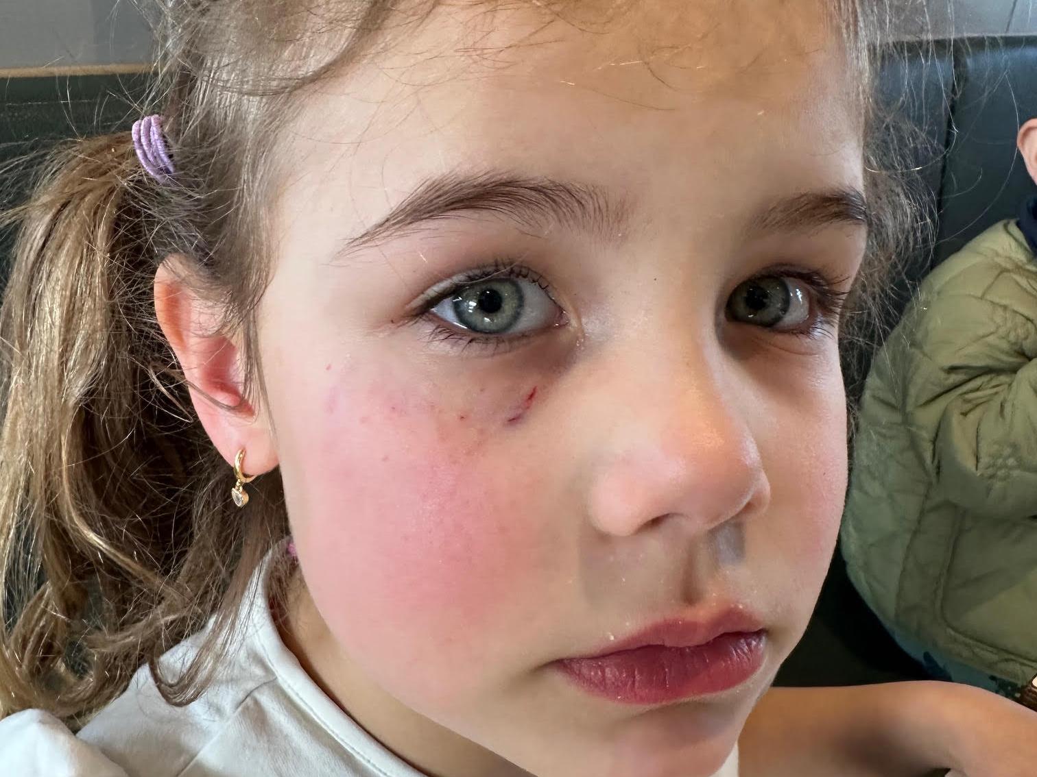 Edith, 5, väntade på mat – blev biten i ansiktet av okänd