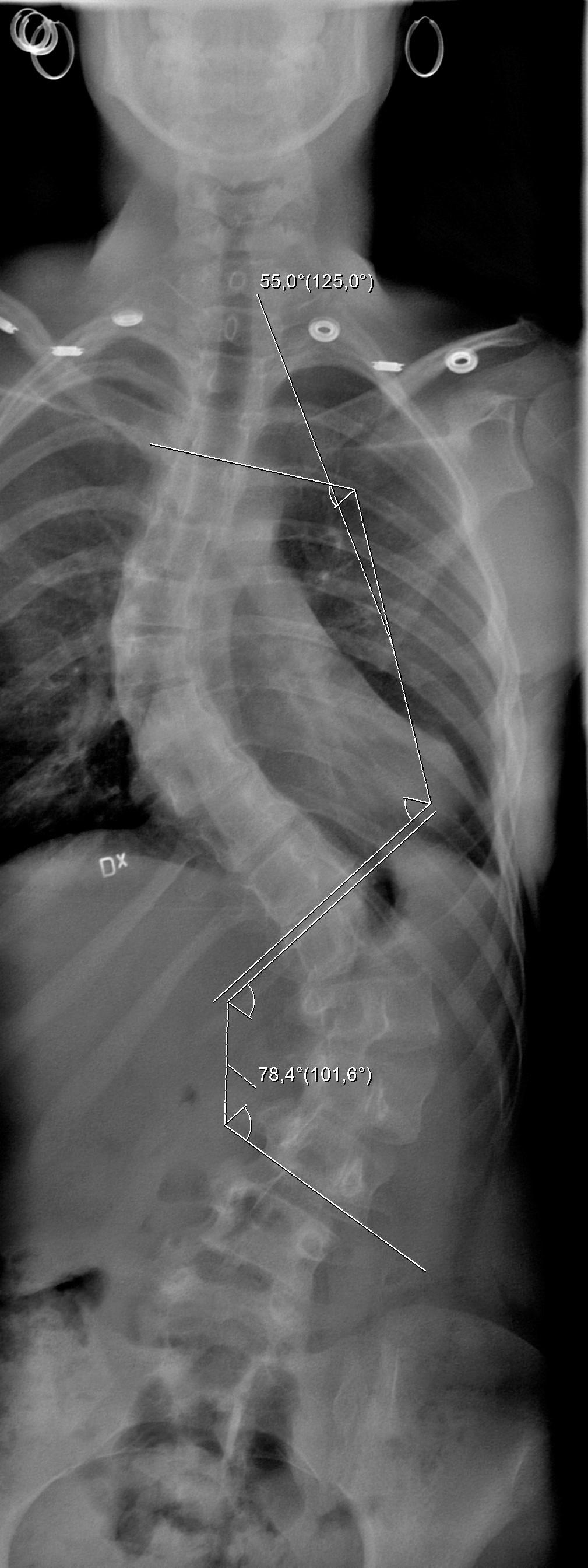 ÅR 2002:  Röntgen före steloperationen. Linda, 12, hade en kraftig S-formad dubbelkrök på ryggraden. Vinkeln på den nedre kröken var 78 grader och på den övre 55 grader.