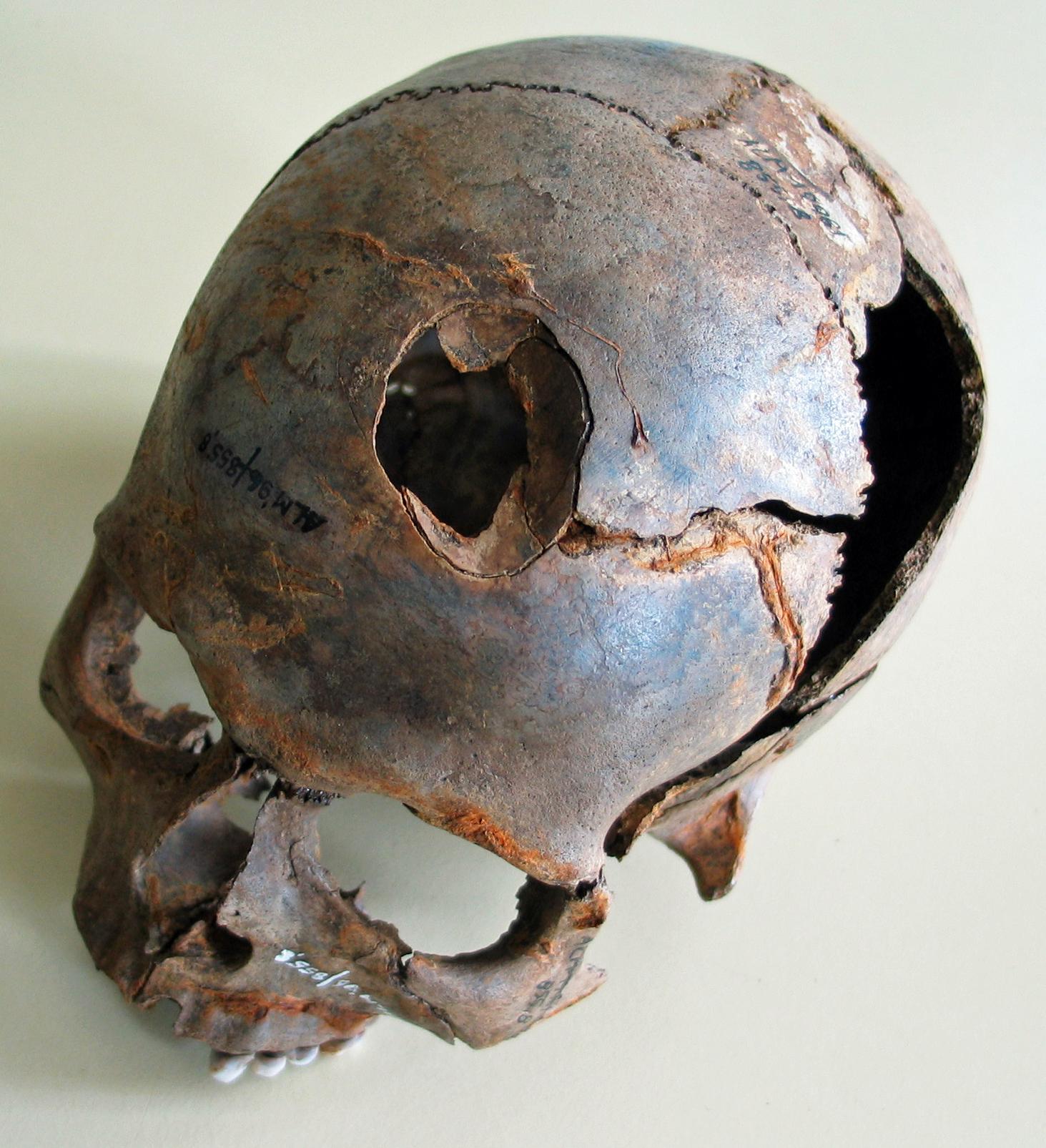 Utöver pilar och spjut användes också trubbigt våld, som denna skalle visar där någon fått skallbenet krossat, kanske av en klubba. Rester från minst 130 människor, alla unga män, har hittills hittats på platsen.