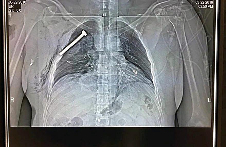 En röntgenbild visar hur en skadad person fått en spik i bröstet-