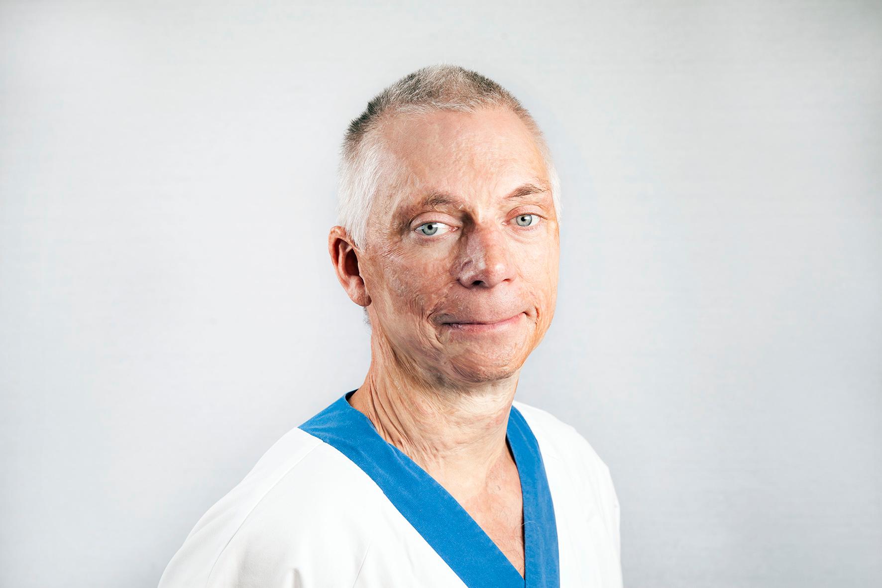 Fredrik Huss, överläkare och docent inom plastik- och käkkirurgi/brännskadecentrum.