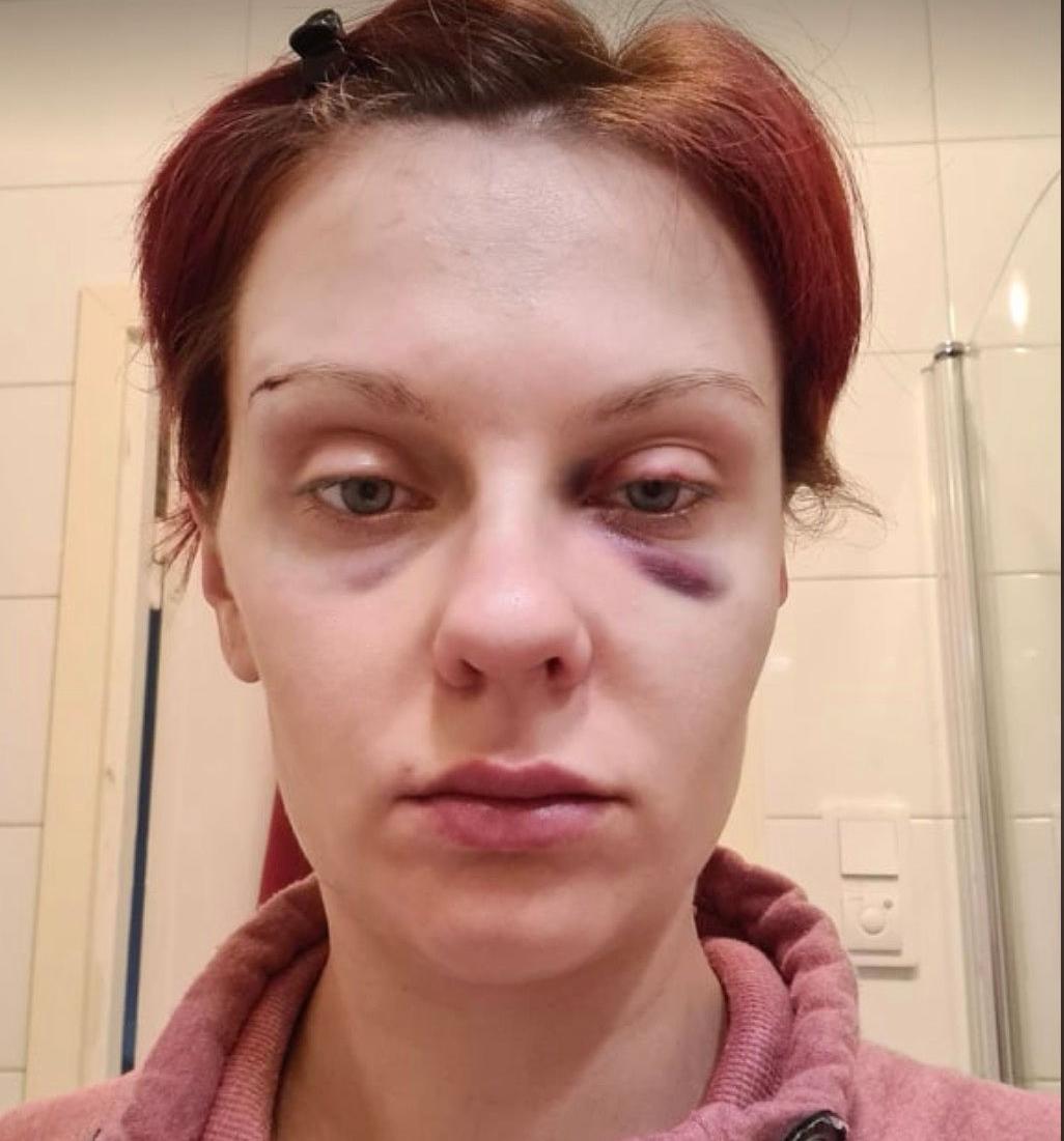 Beata tog bilder med sin mobil på de skador hon fått efter att ha misshandlats av sin make. Hon skickade dem till personer hon litade på.