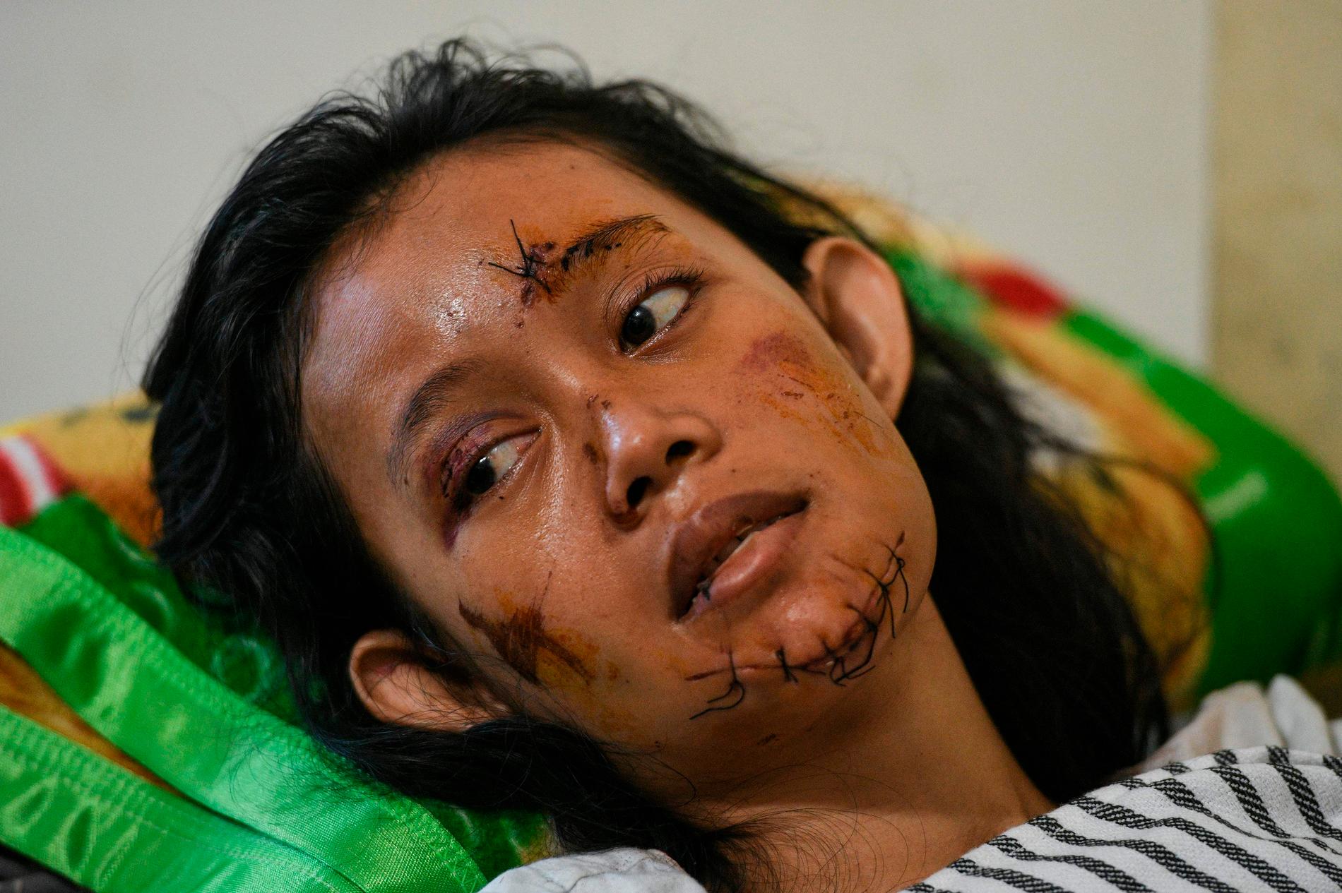 En kvinna som skadats i ansiktet återhämtar sig på sjukhus i Kalianda, Indonesien. 