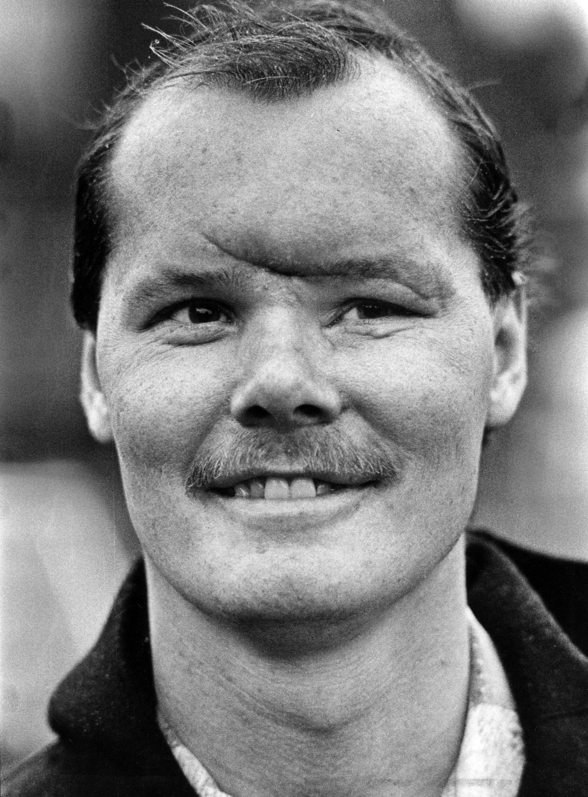 1980. Jan ”Harpo” Svensson efter olyckan.