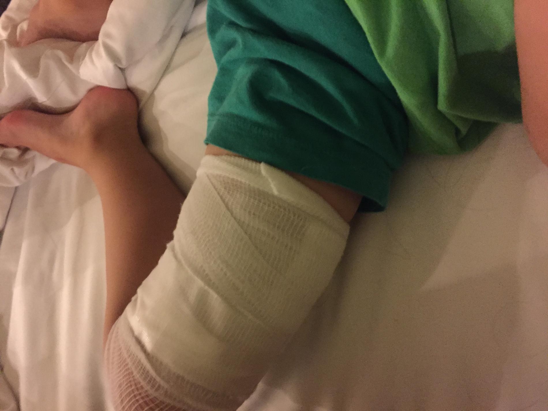 Olas treårige son blev biten i benet. 