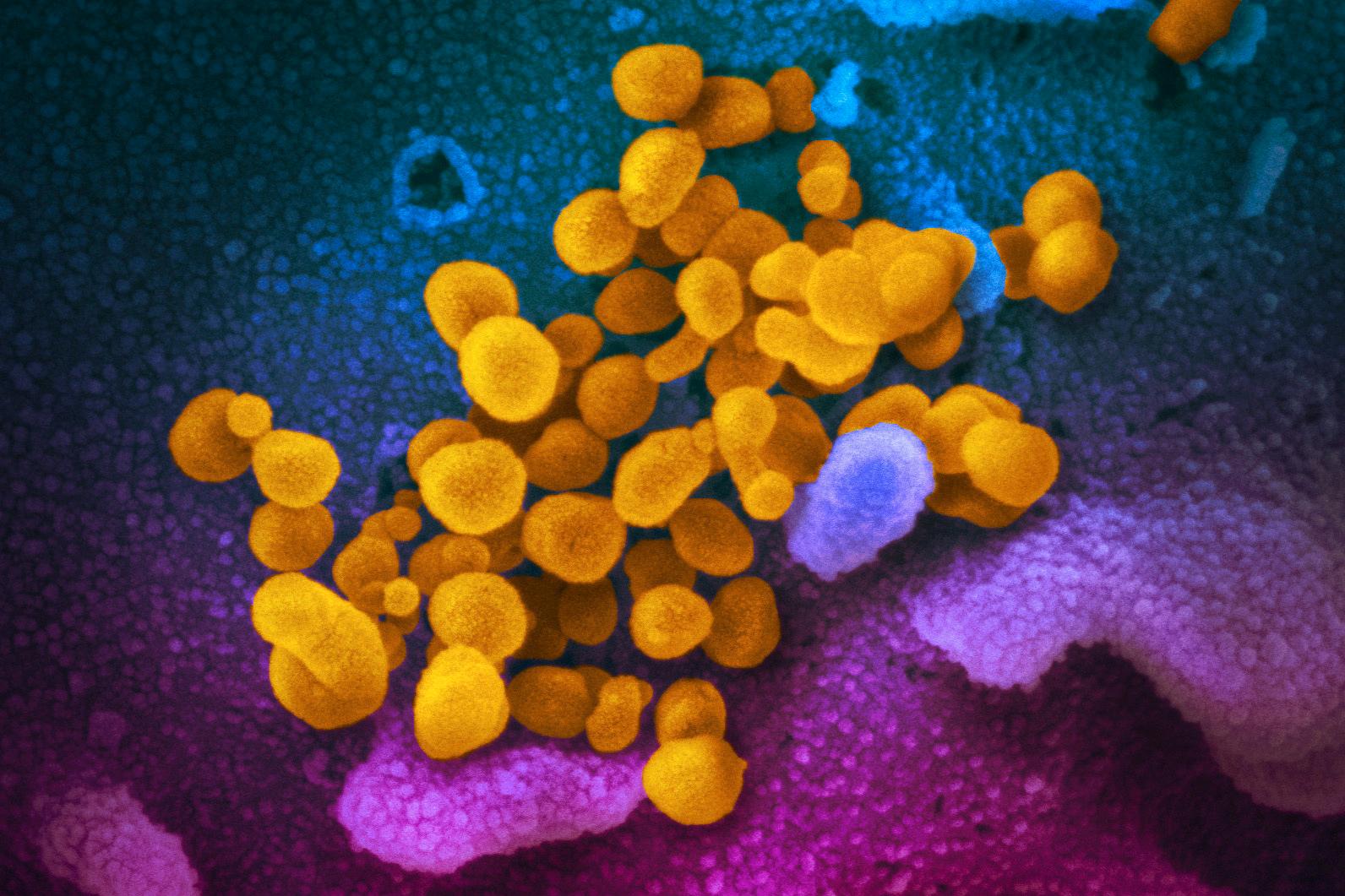 På bilden som tagits med hjälp av ett elektronmikroskop syns det nya coronaviruset sars-cov-2 (gult). Provet togs från en patient i USA. Arkivbild.