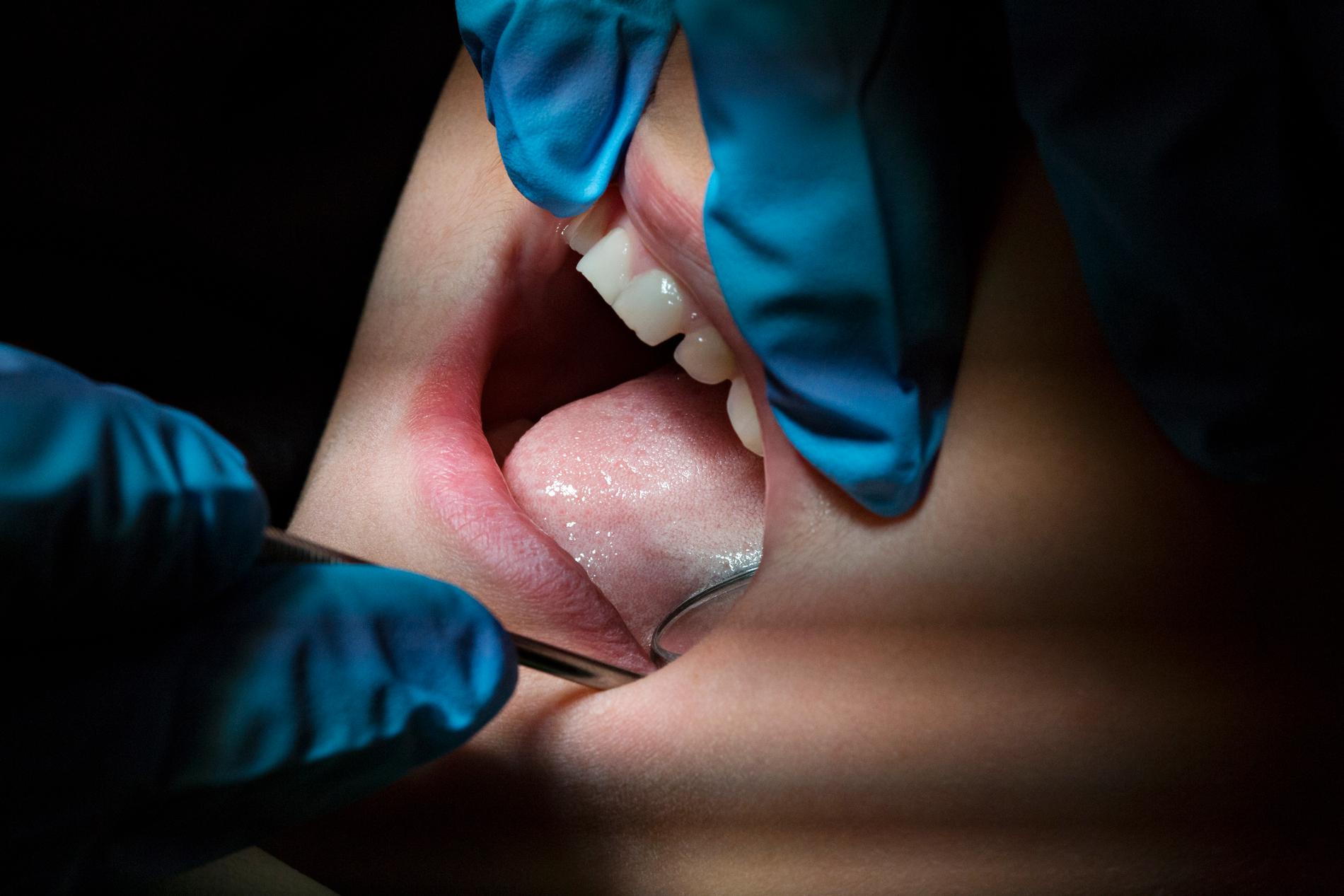 Inspektionen för vård och omsorg kritiserar en privattandläkare i Västra Götaland för att ha slipat ned en kvinnas tänder ända till pulpan. Arkivbild.
