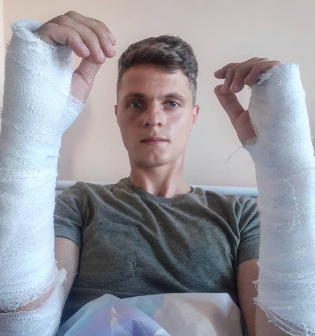 Polis bröt båda armarna på den belarusiske journalisten Ruslan Kulevitj den 11 augusti.