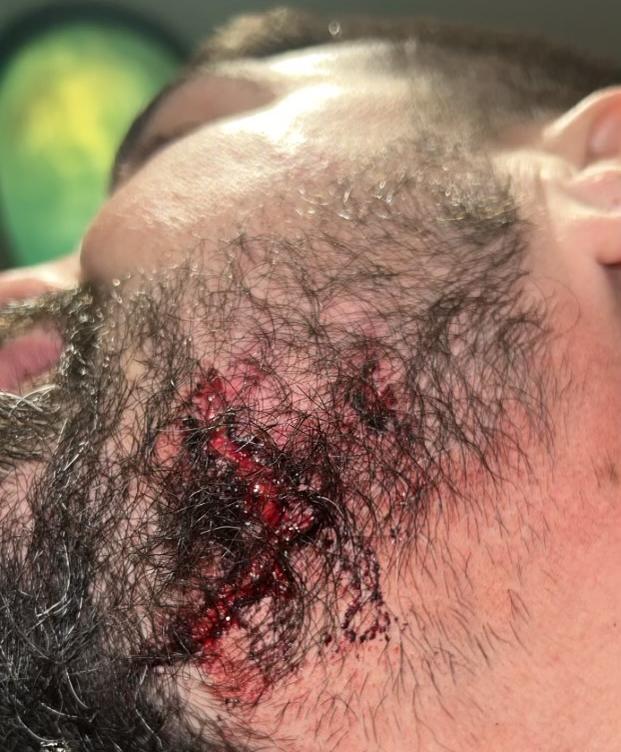 Adrian blev biten vid käken. Bilden togs kort efter attacken.